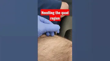 Dry Needling for muscle twitching | Physical Therapy