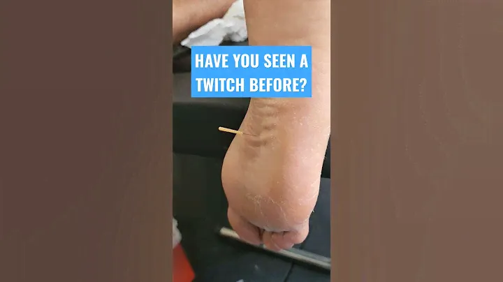 Dry needling muscle twitch response in the foot.