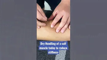 Calf muscle dry needling with muscle twitch to reduce stiffness